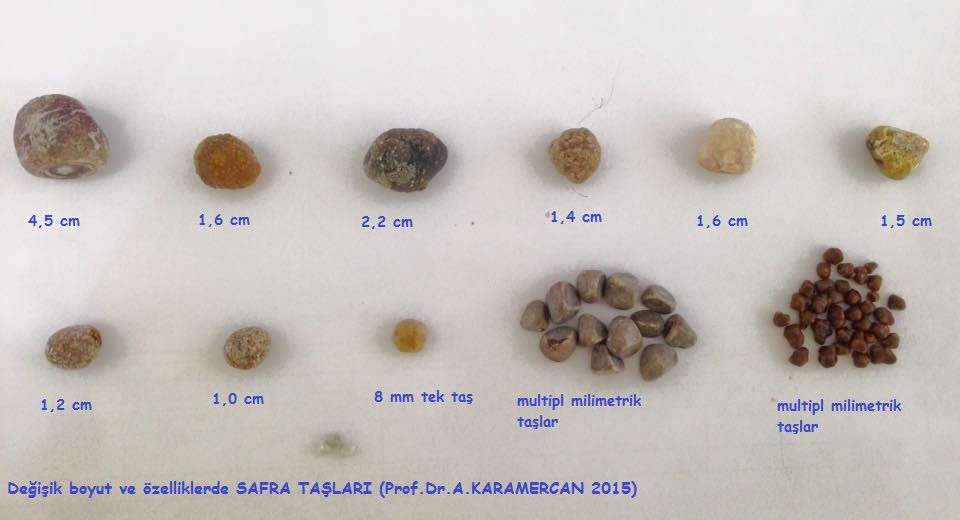 safra kesesi tası belirtileri