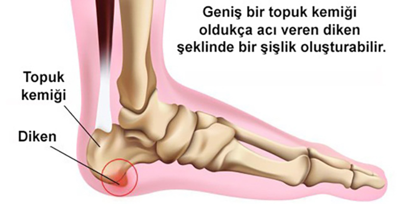 topuk dikeni dogal tedavi vicks krem